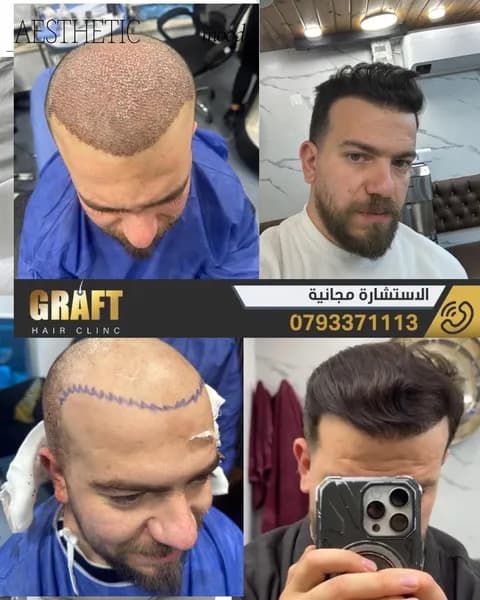 صور قبل وبعد لعملية زراعة شعر لرجل تظهر مراحل التخطيط والنتائج النهائية الكثيفة.